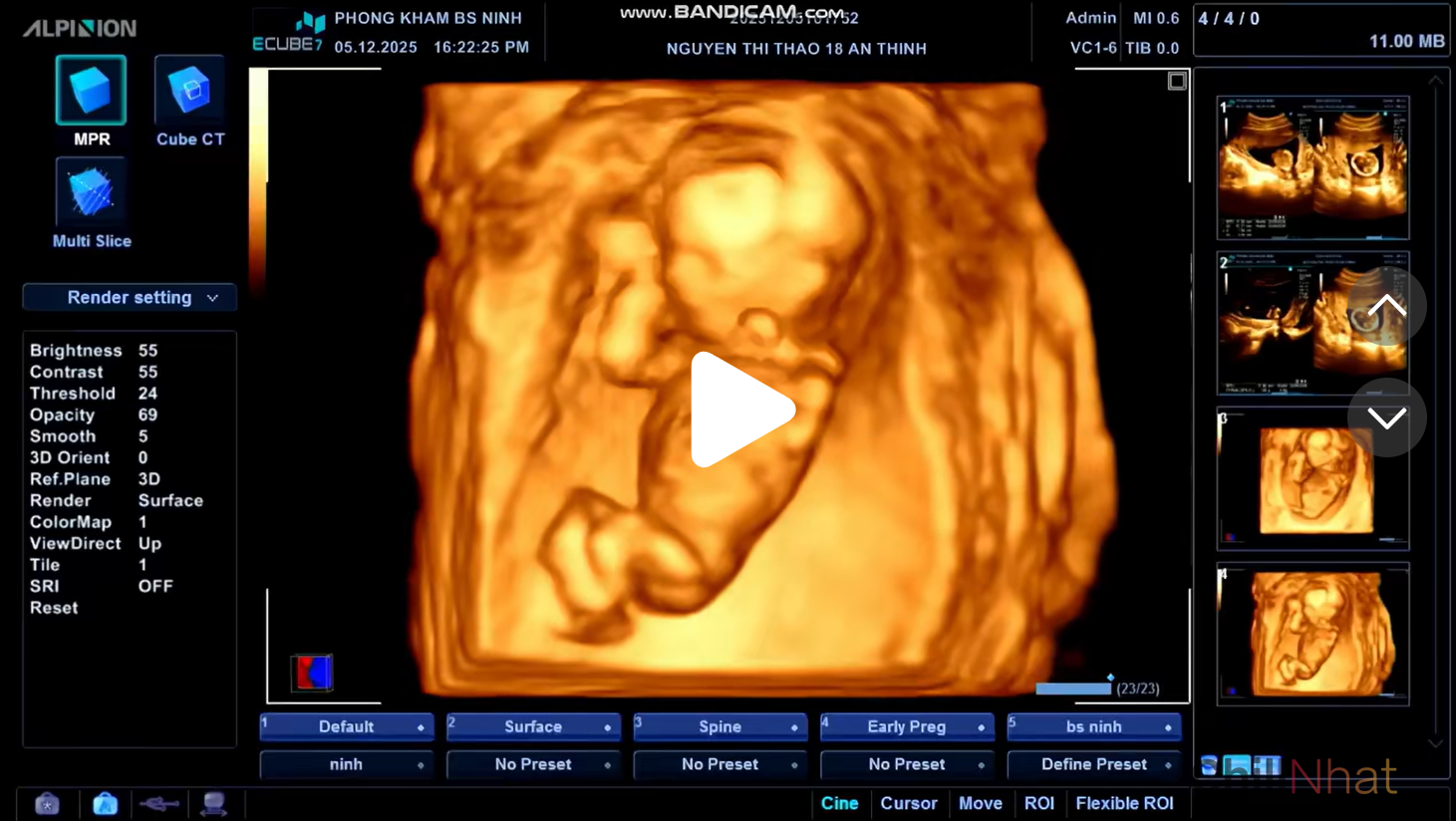 Tôn Bằng háo hức khoe vợ mang thai con gái